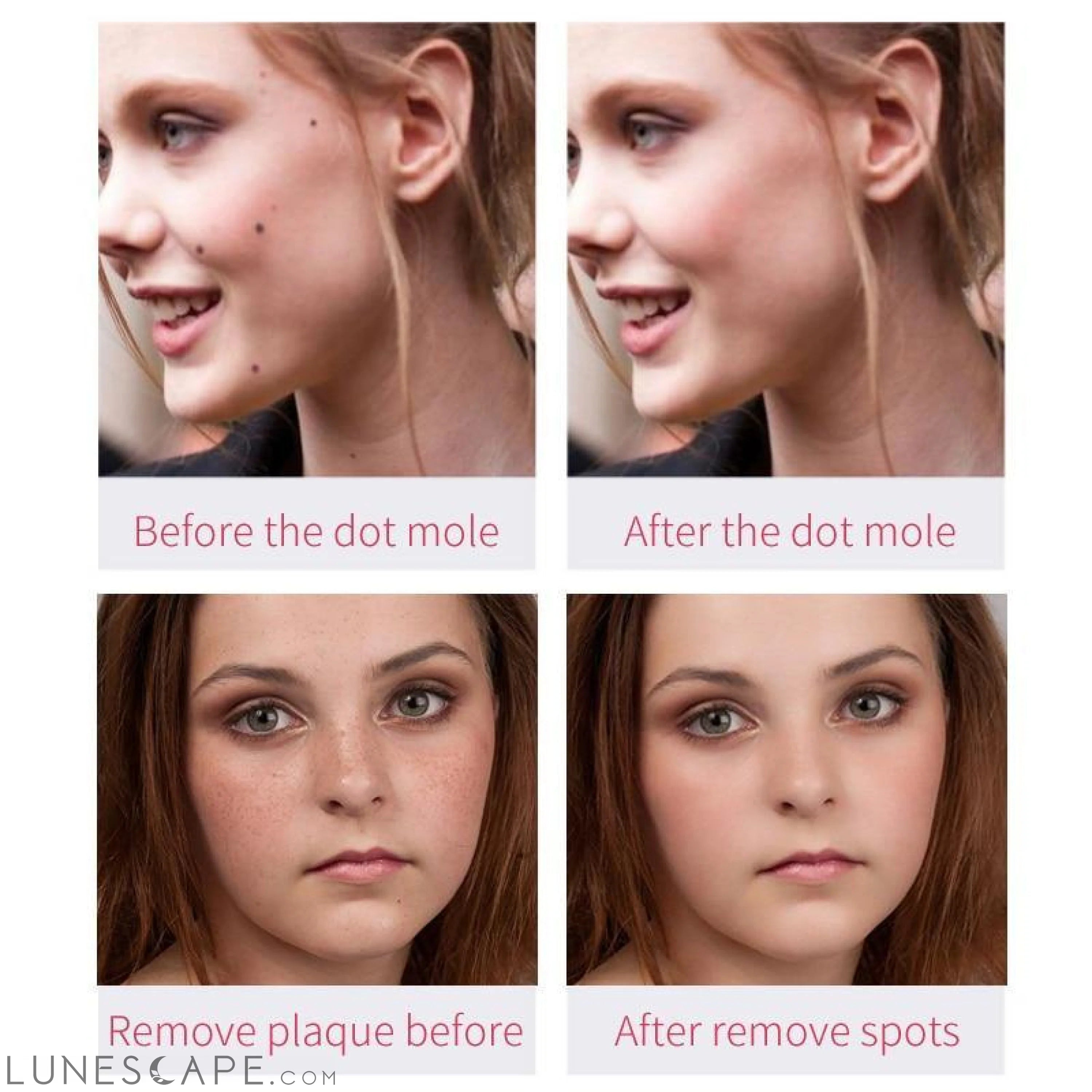 Laser Mole & Blemish Removal Pen LUNESCAPE